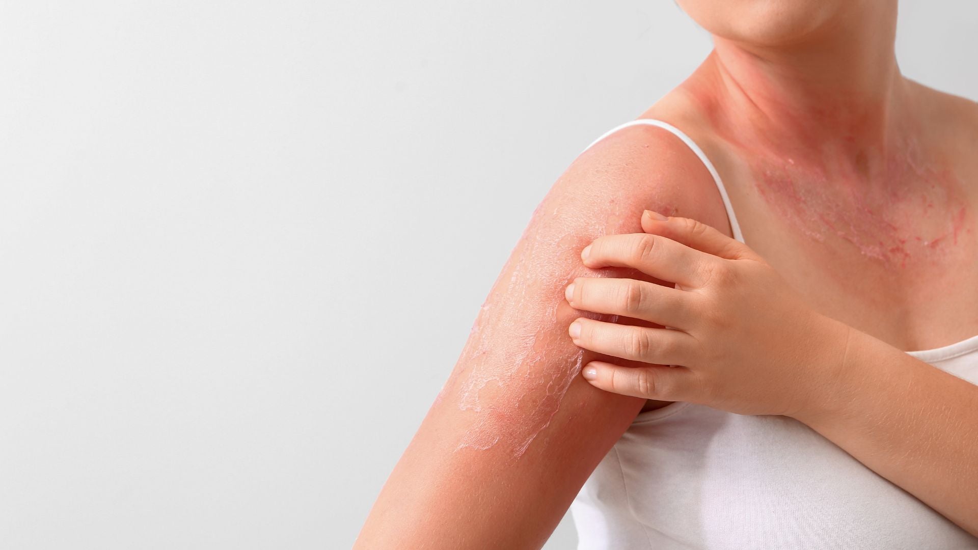 Magnesium and Sunburn Relief: Soothing Sun-Damaged Skin